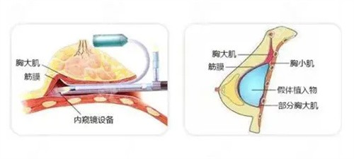 济南诺德内窥镜大自然丰胸