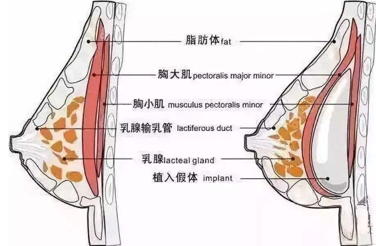 高超医生隆胸