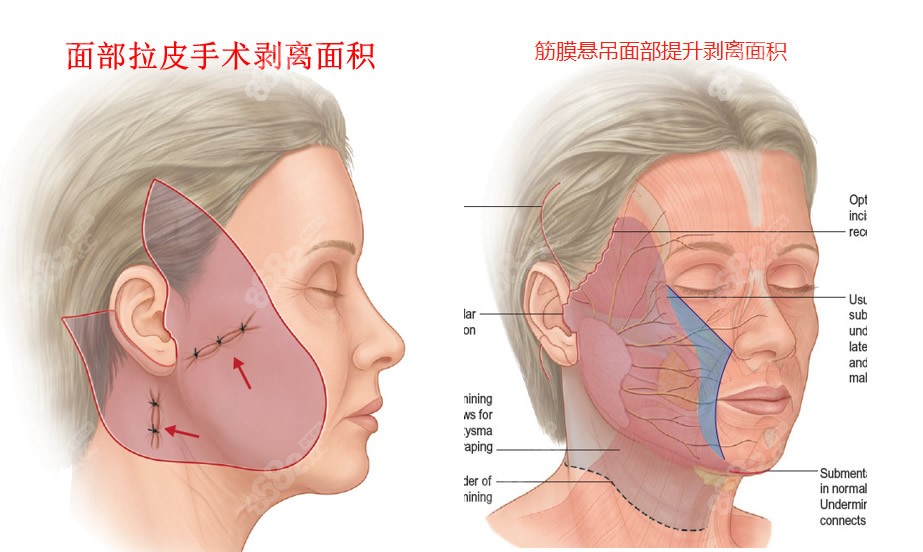 筋膜悬吊面部提升可以提拉法令纹和嘴角纹