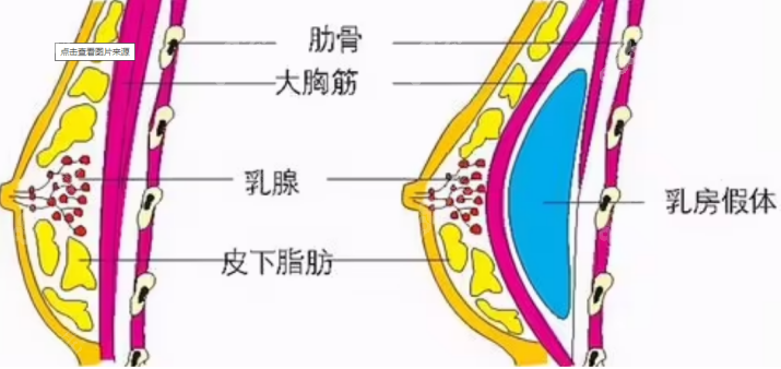 曾昂医生隆胸技术怎么样？