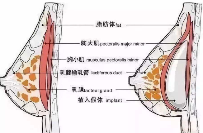 侯泽民医生做隆胸手术