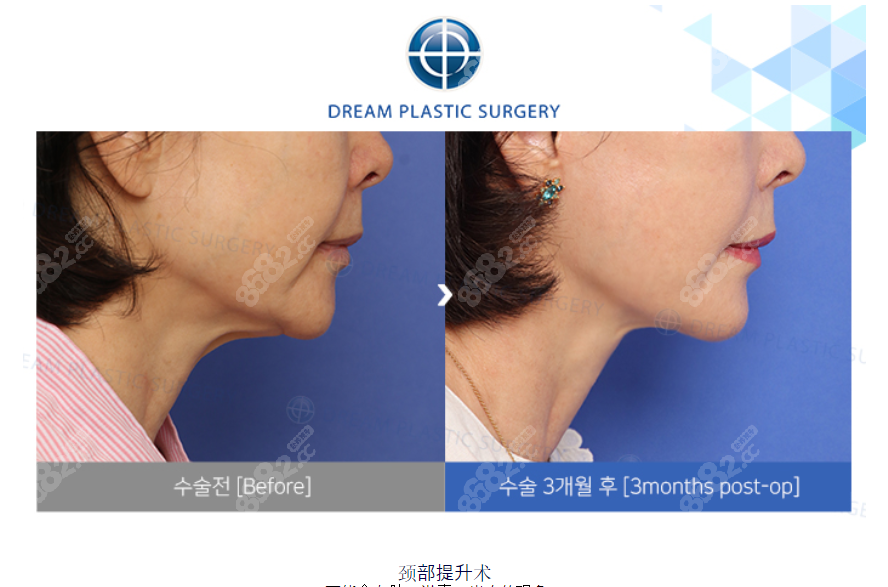 韩国梦想医院颈部拉皮提升三个月对比图片