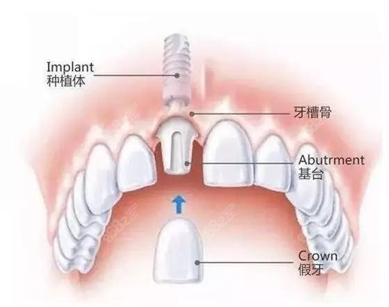 拔牙后镶牙好还是种牙好8682.cc