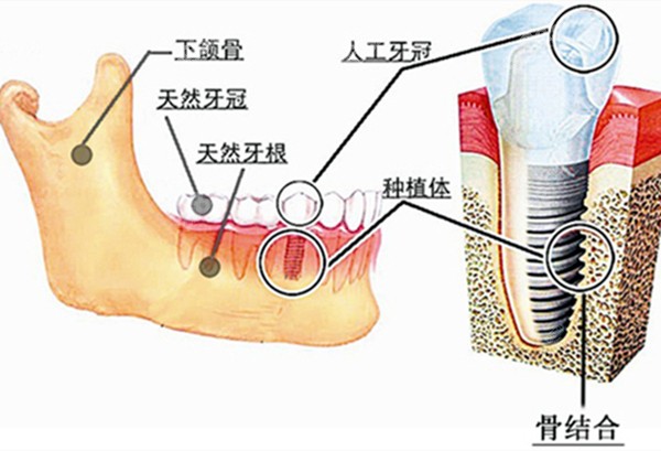 种植牙在牙槽骨内的图