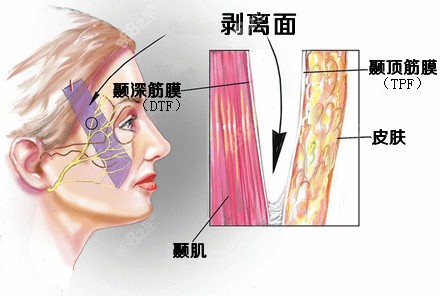 smas颞部筋膜提升术示意图