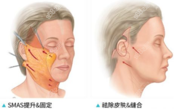 筋膜提拉手术操作过程图解