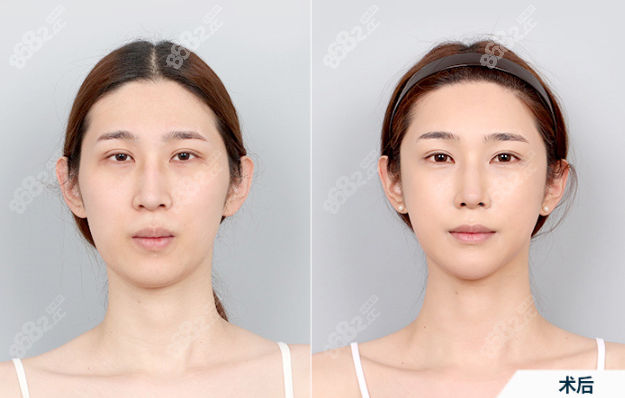 3,韩国da凸嘴手术前后对比照片
