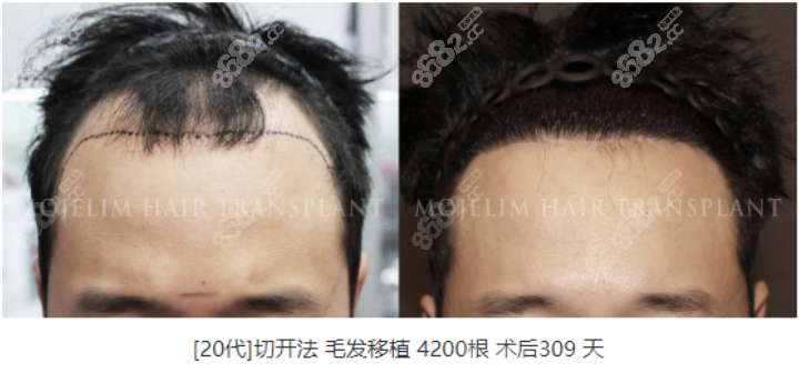 韩国毛杰琳整形医院真人实例