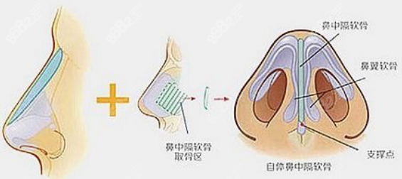 隆鼻手术