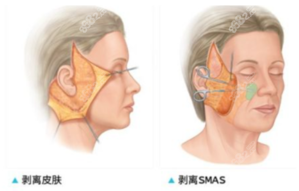 筋膜提拉手术是怎么操作的