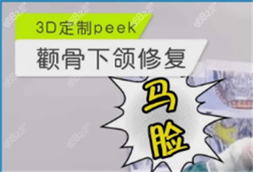 上海时光整形医院何晋龙医生peek材料修复颧骨反馈