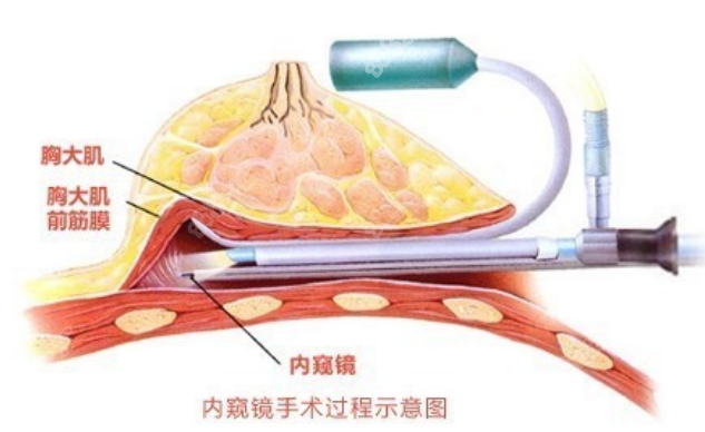 侯泽民医生做隆胸手术