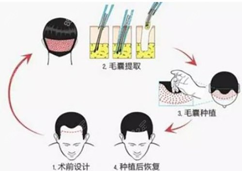 植发流程