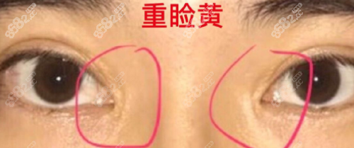 韩国eve可以修复的眼角疤痕