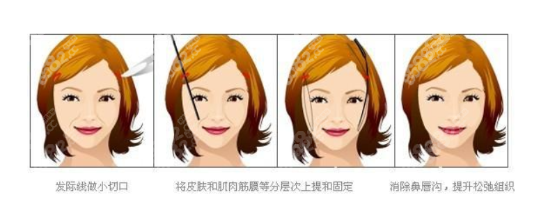 筋膜悬吊面部提升术怎么做