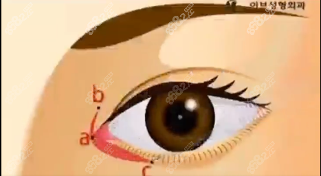 韩国eve修复眼角