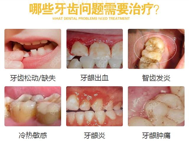 厦门湖里力锜第三口腔补牙/洗牙价格