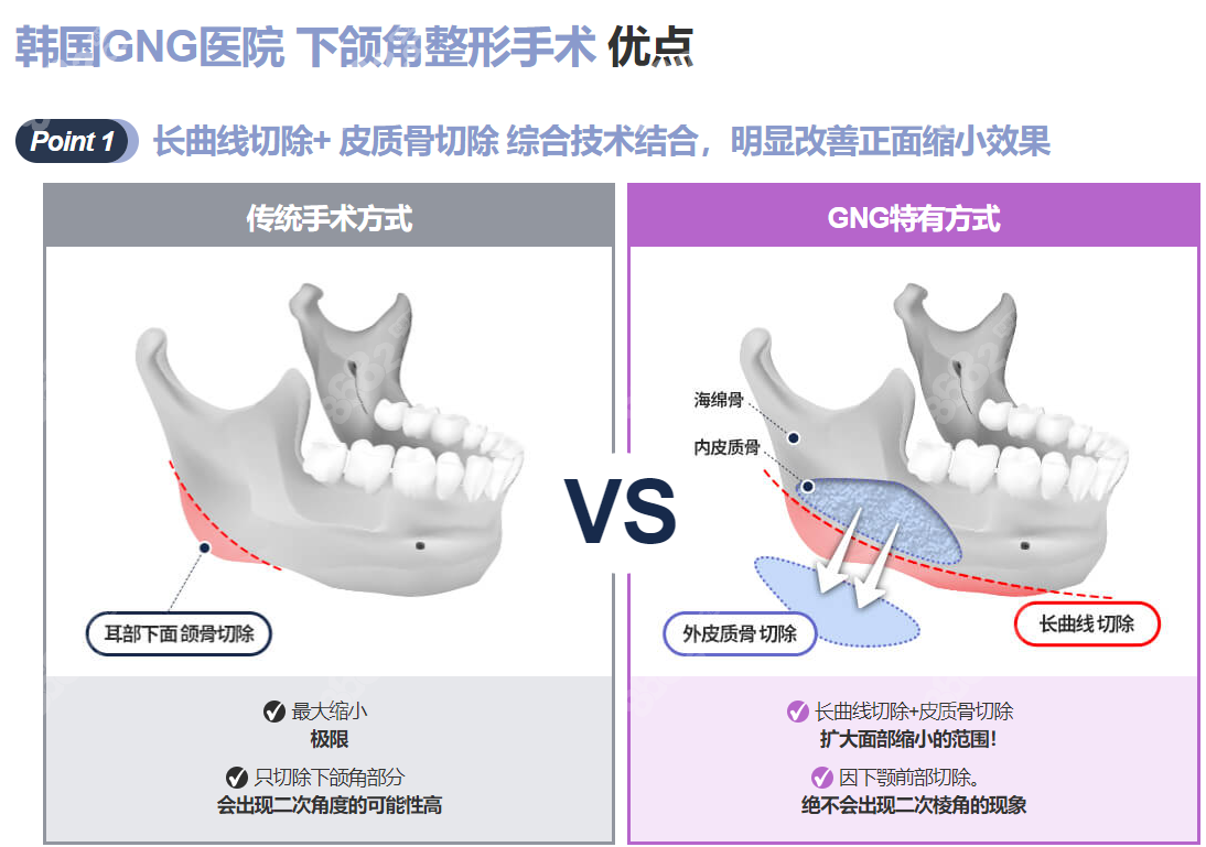 韩国gng医院下颌骨磨骨怎么样8682.cc