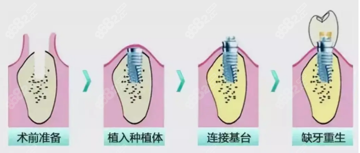 上海伸博口腔医院种植牙