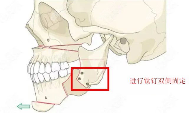 面部轮廓修复好的医院8682网