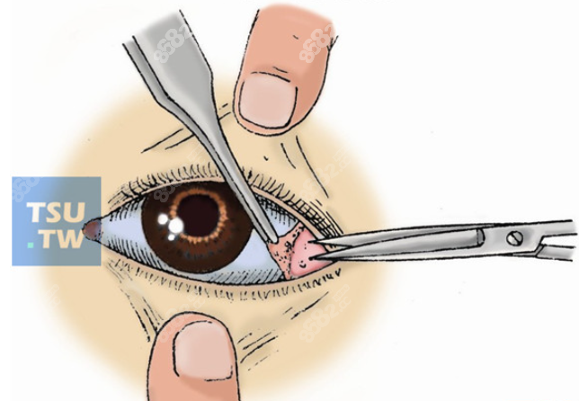 fox改良法外眦开大术过程图示