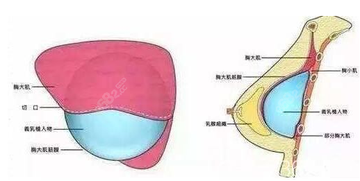 艺星隆胸好的医生实力强