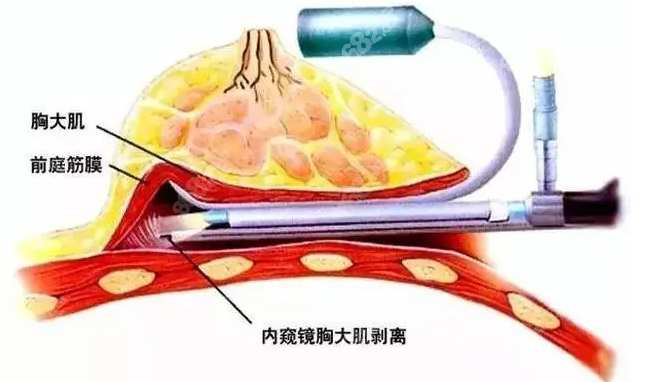 上海美立方王志刚医生深V天鹅弧假体隆胸技术是好