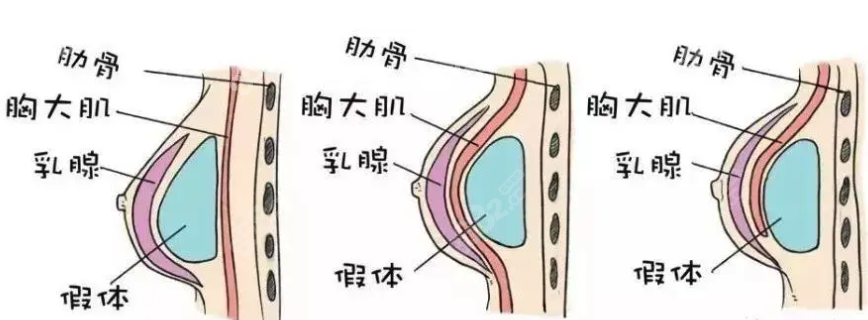 西安高一生假体隆胸