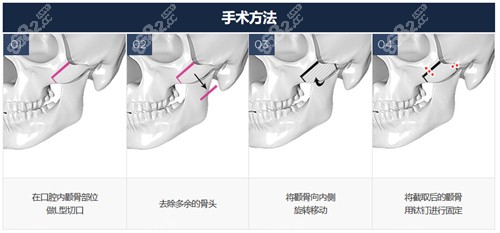 韩国GNG整形医院金慧英做颧骨缩小技术高超