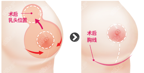 杭州栗勇医生缩胸技术好吗