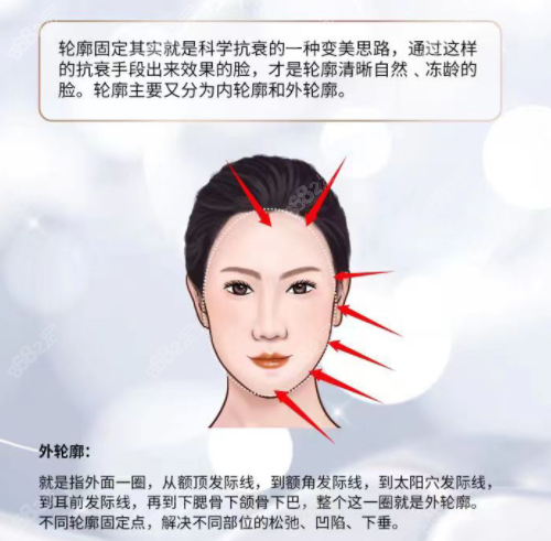 轮廓固定