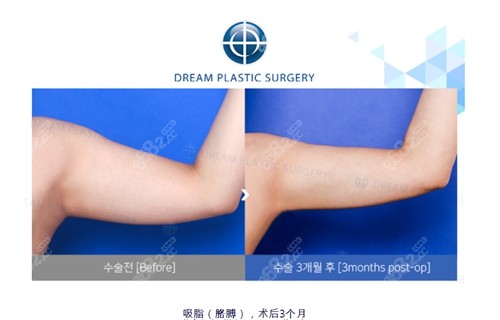 韩国梦想整形外科医院手臂吸脂实例