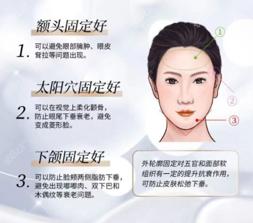 轮廓固定