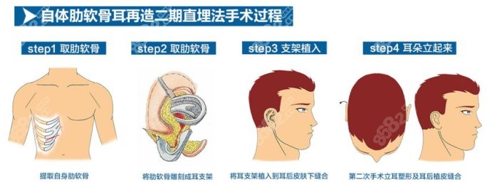 肋骨耳再造手术过程