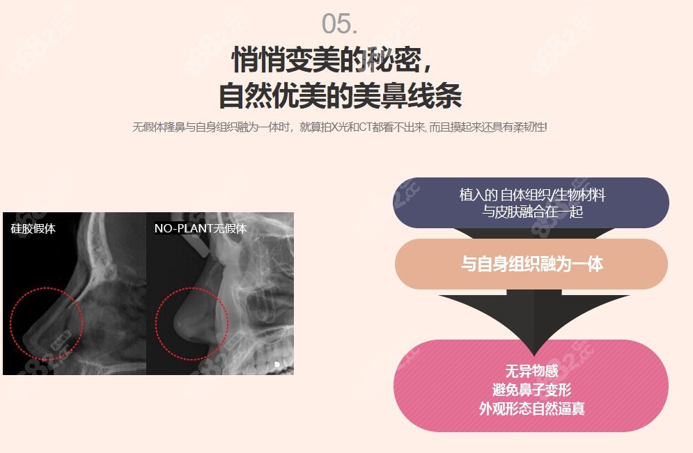 韩国gng整形医院做鼻修复优势
