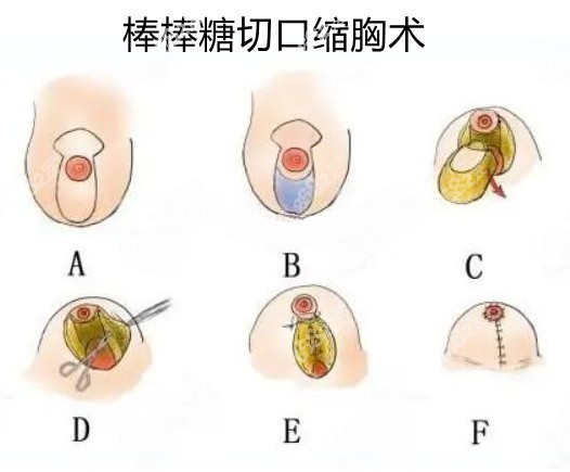 栗勇医生缩胸手术过程