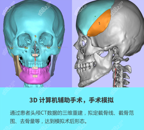 3D打印颌面修复技术优势