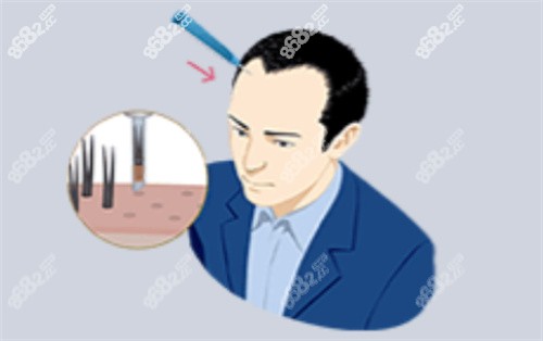 泉州植发价格是多少？