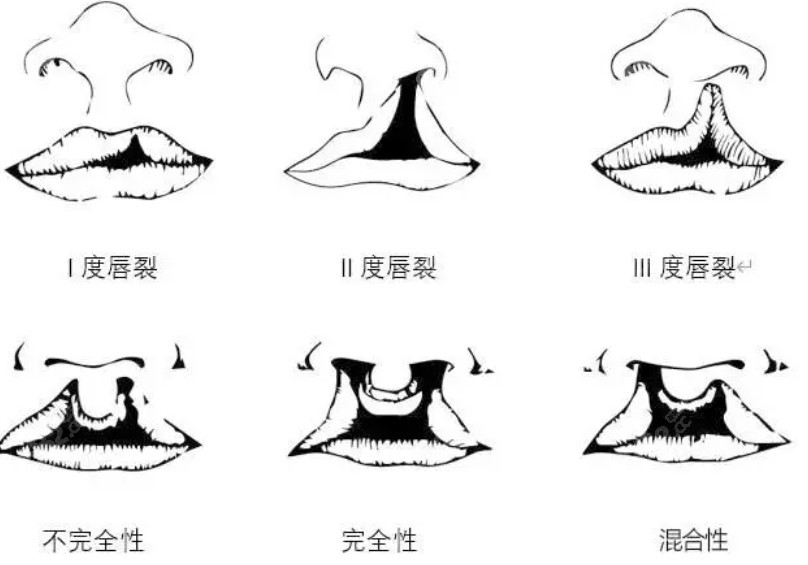 国内兔唇修复费用低又好医院8682网