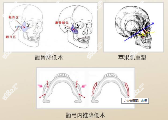 潘宝华做颧骨怎么样