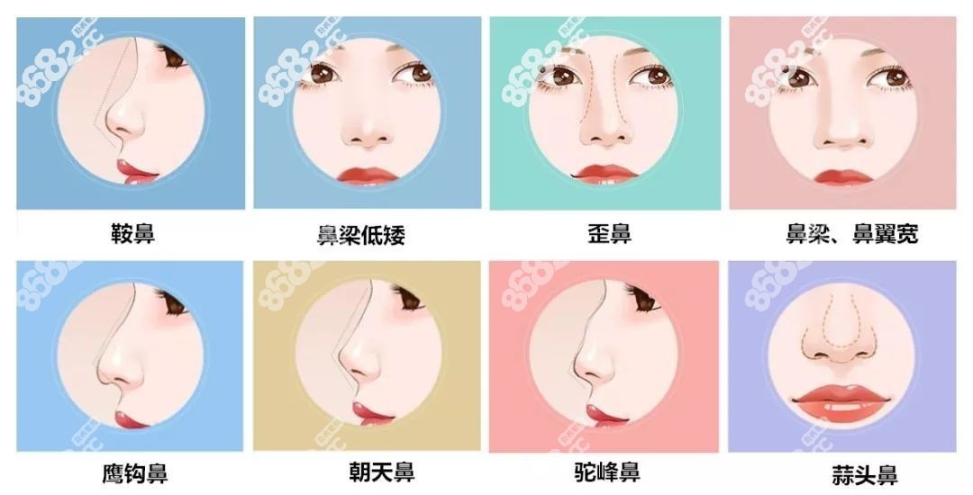 深圳宝丽李信锋医生可以改善鼻型