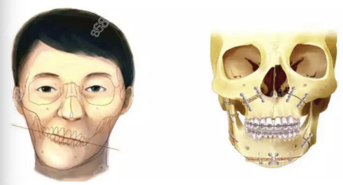 就是面部歪斜比較明顯,主要就是因為頜骨發育畸形的問題導致的歪臉