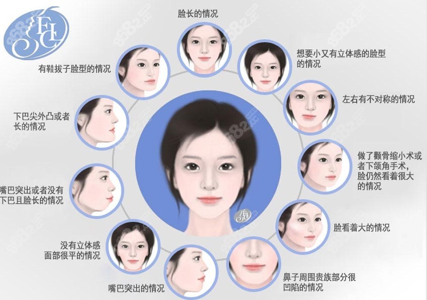 韓國(guó)雙鄂手術(shù)新技術(shù)smart雙鄂手術(shù)改善臉型問(wèn)題8682網(wǎng)