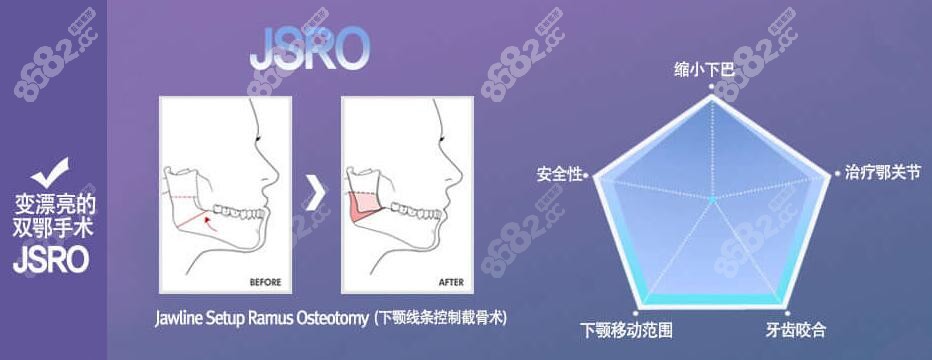 韩国菲斯莱茵(JSRO) 智能双颚手术价格m.8682.cc