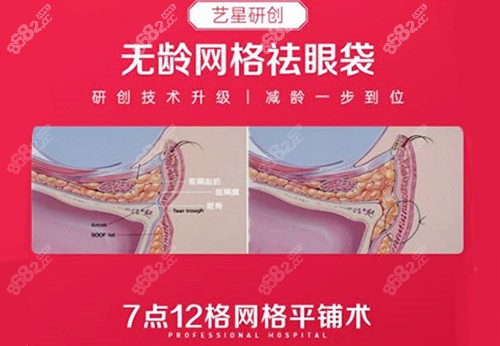 杭州艺星医疗美容祛眼袋技术