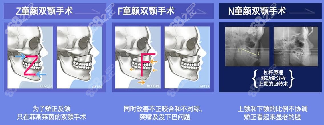 韩国菲斯莱茵双鄂手术价格