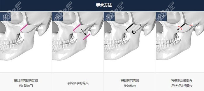 金惠英医生做颧骨手术的原理图