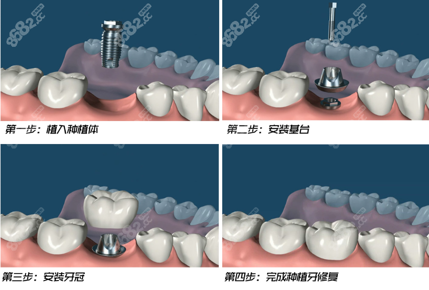 芜湖德瓦口腔种植牙价格