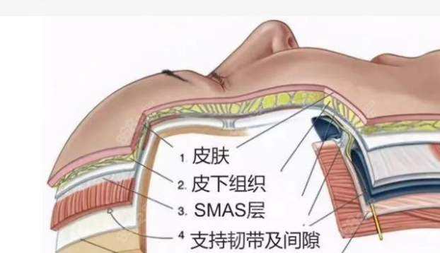 黄广香医生拉皮手术好