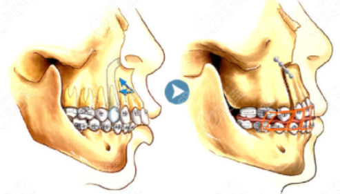 正颌手术过程图